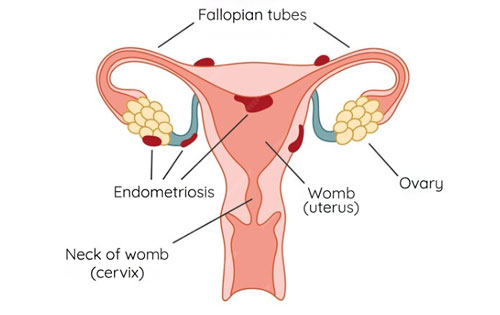 Endometriosis