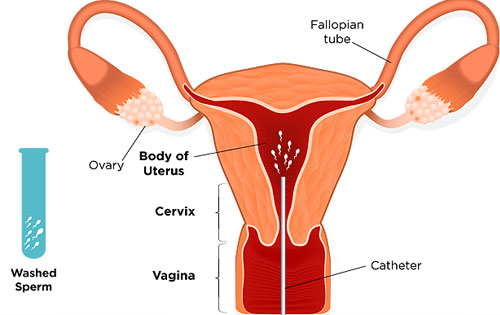IUI Treatment