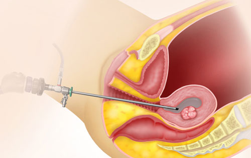 Hysteroscopy