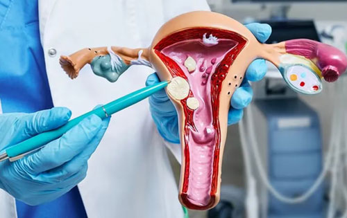 Best Doctor For Fibroid Treatment in Panvel