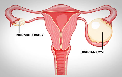 Ovarian Cyst