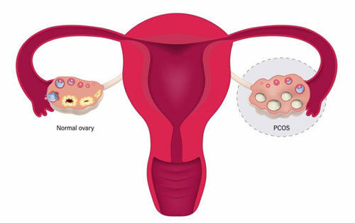 PCOS