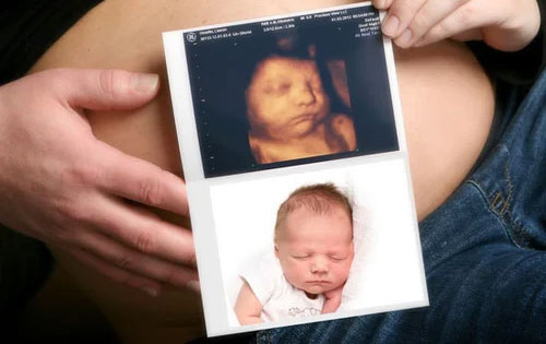 3D-4D Sonography